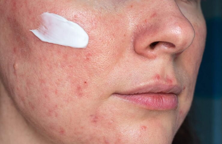 rosacea